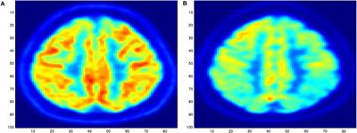 A Novel Sonification Approach to Support the Diagnosis of Alzheimer’s Dementia